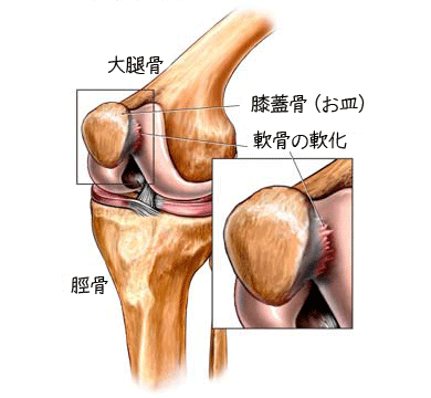 膝蓋軟骨軟化症.gif