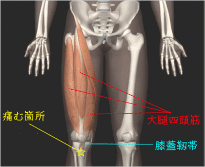 オスグッド大腿四頭筋.gif