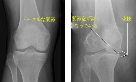 変性性膝関節症x-ray